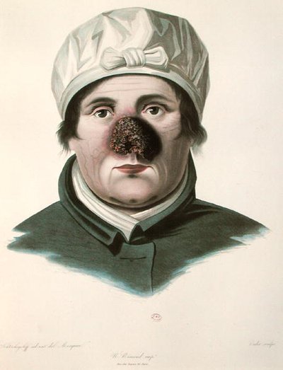 Före en hudtransplantationsoperation, från 