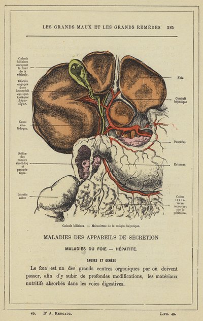 Gallsten, Mekanism av hepatisk kolik (färg litho) av French School