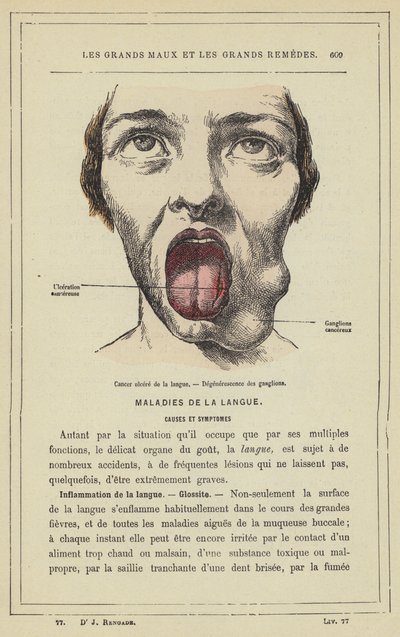 Cancer i tungsår, degeneration av lymfkörteln (färg litho) av French School