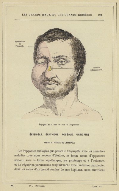 Progressiv erysipelas i ansiktet (färg litho) av French School