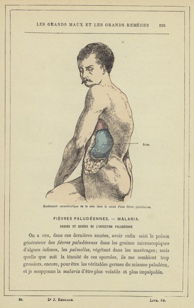 Karakteristisk svullnad av mjälten under malariafeber (färg litho) av French School