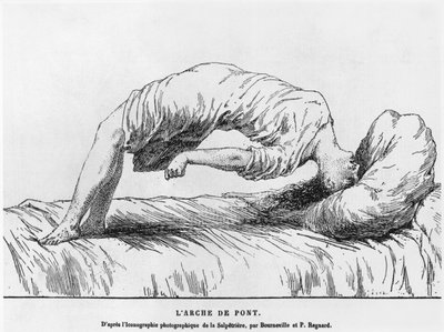 Hysteri och somnambulism, från Les Maladies Endemiques de l