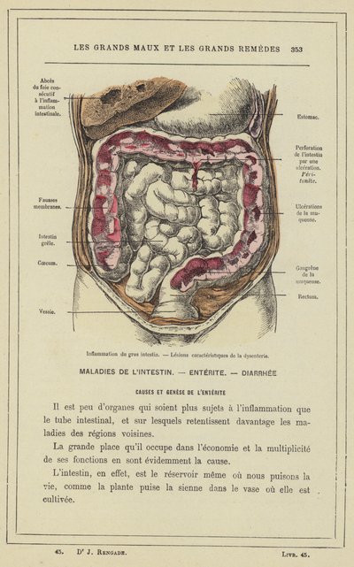 Inflammation i tjocktarmen, lesioner karakteristiska för dysenteri (färg litho) av French School
