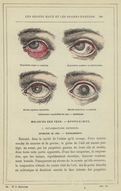 Ytliga ögoninflammationer, Oftalmi (färg litho) av French School