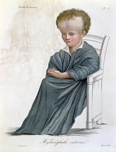 Intern Hydrocephalus, från Nosologie Naturelle av Baron Jean Louis Alibert (1768-1837) graverad av Tresca, 1817 av French School