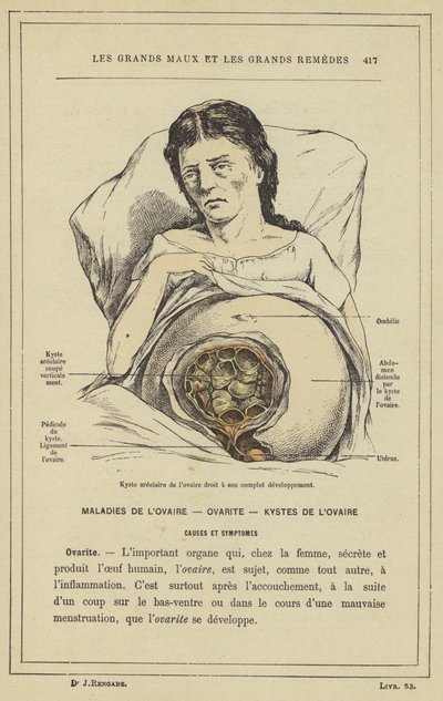 Areolär cysta i höger äggstock i full utveckling (färg litho) av French School