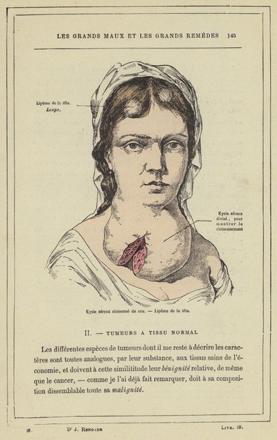 Cloisonne serös cysta i halsen, Lipom i huvudet (färg litho) av French School