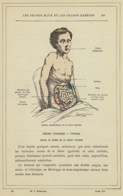 Karakteristiska lesioner av tyfoidfeber (färg litho) av French School