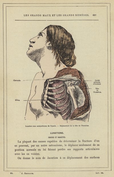 Subcoracoid dislokation av axeln, Förskjutning av huvudet på humerus (färg litho) av French School