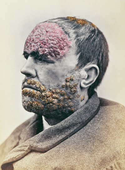 Man som lider av syfilis, från ett fotografi taget för Clinique Photographique de l