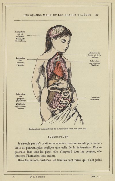 Karakteristiska manifestationer av tuberkulos hos en ung flicka (färg litho) av French School