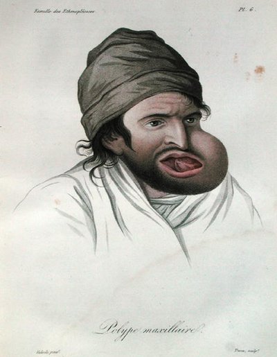 Maxillär polyp, från en bok av Baron Jean Louis Alibert (1768-1837) 1817 (färgad gravyr) av French School