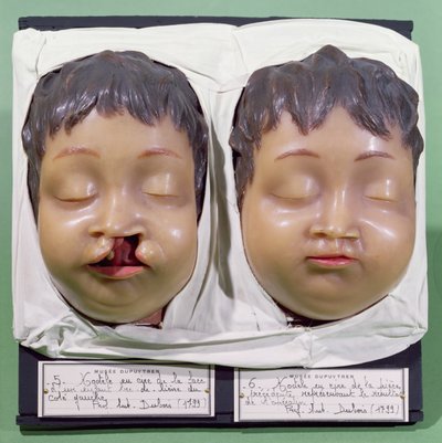 Modell som visar ett barns ansikte före och efter en operation för att korrigera en hareläpp utförd av Antoine Dubois (1756-1837) 1799 (vax) av French School