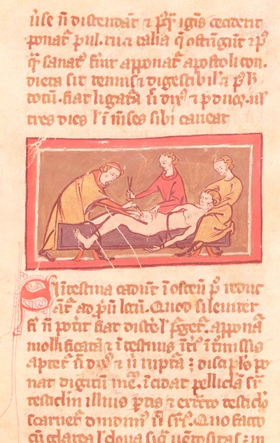 Ms H 89 fol.23 Surgery, från en upplaga av Book of Surgery av Rogier de Salerne av French School