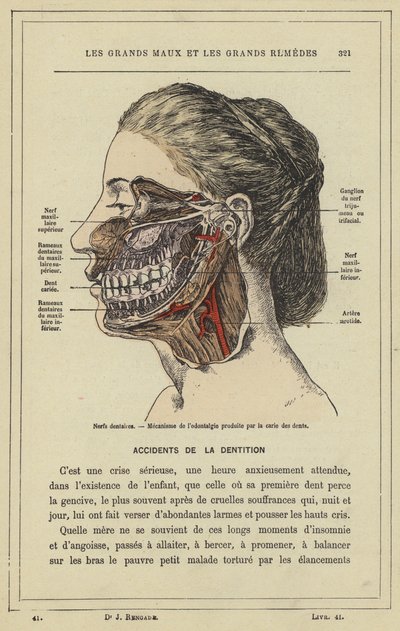 Dentala nerver, Mekanism för odontalgi som orsakas av karies (färg litho) av French School