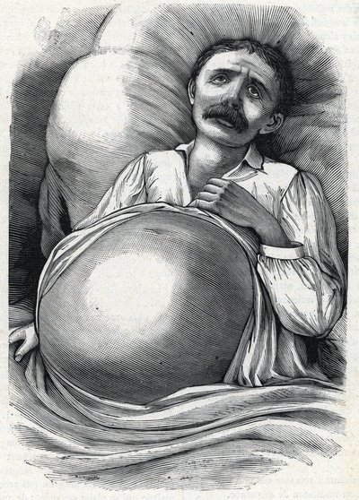 Patient med avancerad levercirros (gravyr) 1888 av French School