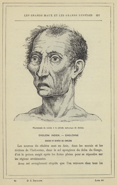 Fysiognomi av patienten under asfyxiperioden av kolera (färg litho) av French School