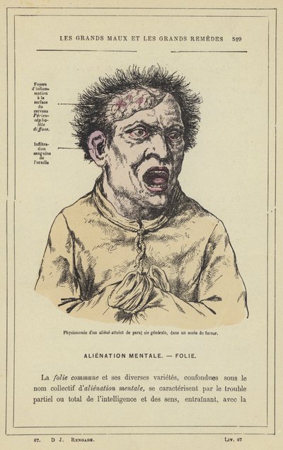 Fysiognomi av en utomjording som drabbats av paral sie generale, i ett raseri (färg litho) av French School