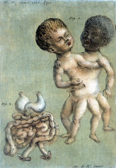 Platta med medicin som representerar siamesiska bröder: en vit och en svart. illustration av Toussaint (1756) i "Periodic Observations on Physics, Natural History and the Arts". av French School
