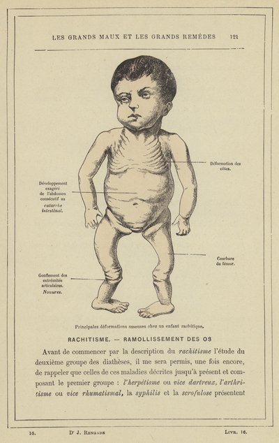 Huvudsakliga bendeformationer hos ett barn med rakitis (färg litho) av French School