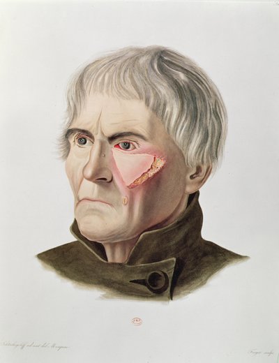 Hudtransplantatoperation, från Selecta Praxis Medico-Chirurgica av Alexander Auvert, Paris, 1856 av French School