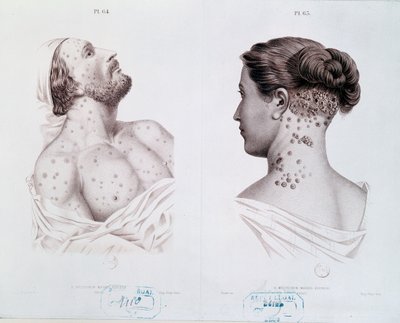 Symtom på syfilis hos män och kvinnor, från en medicinsk bok, c.1850-60 av French School