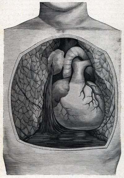 aneurysm ruptur (gravyr) 1888 av French School