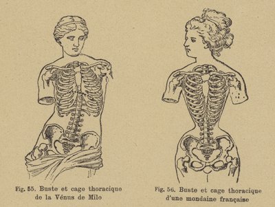Jämförelse av formen på bröstet och bröstkorgen på Venus de Milo med formen på en fransk socialist från sent 1800-tal av German School