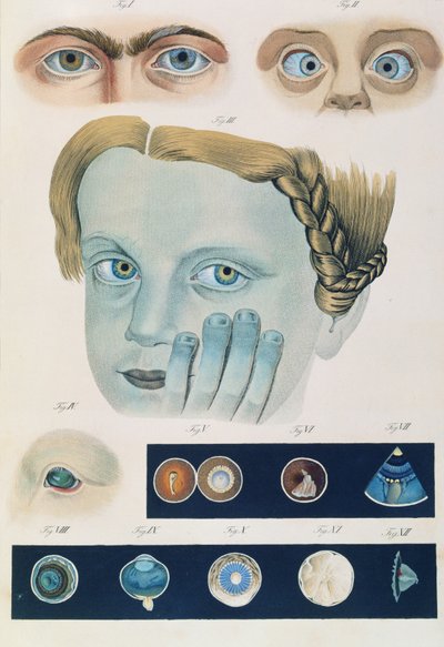 Beskrivning av medfödda ögonavvikelser, från kliniska presentationer av det mänskliga ögats sjukdomar och synfel, av Friedrich August von Ammon (1799-1861) 1838 av German School