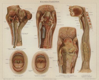 Sjukdomar i halsen (färg litho) av German School