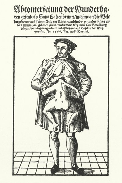 Hans Kaltenbrunn och hans outvecklade sammanfogade tvilling (gravyr) av German School
