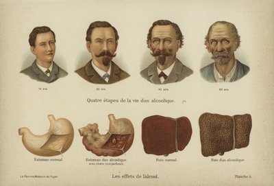 Effekterna av alkoholmissbruk (color litho) av German School
