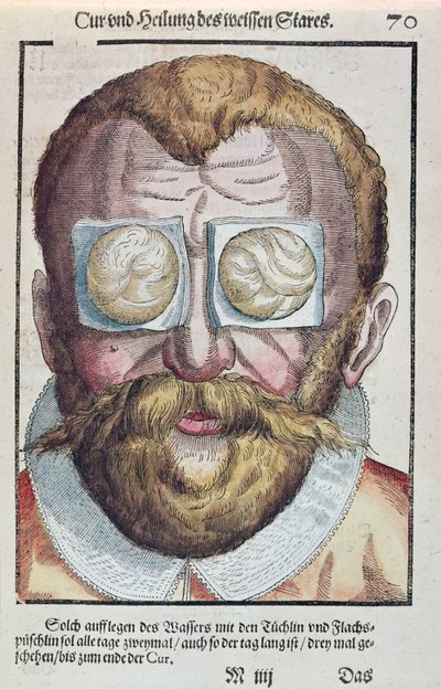 Treating an eye condition, från Ophthalmodouleia av Georg Bartisch (1535-1636) publicerad i Dresden 1583 (träblock i färg) av German School