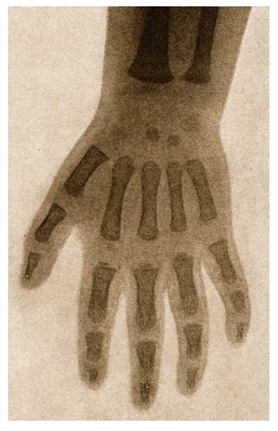 Röntgen av ett barns hand c.1890 av German School