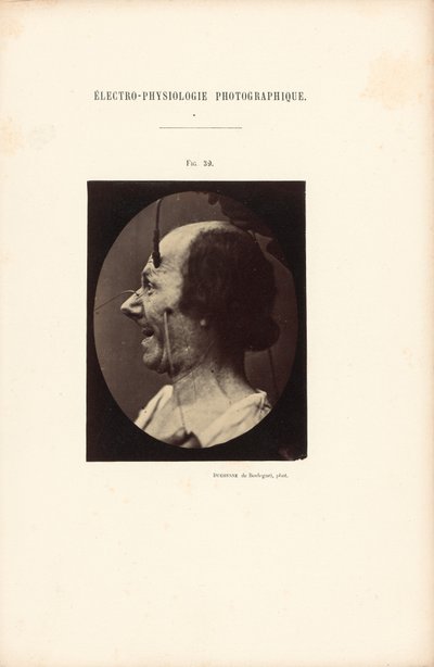 Fotografisk elektrofysiologi, figur 39 av Guillaume Benjamin Duchenne