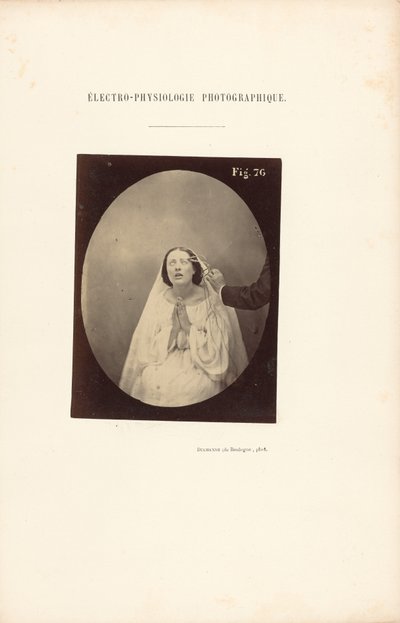 Fotografisk elektrofysiologi, figur 76 av Guillaume Benjamin Duchenne