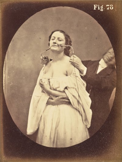 Fig. 78 av Guillaume Benjamin Duchenne