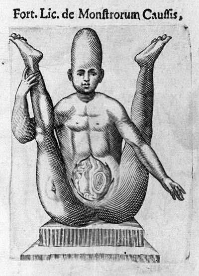 Mänskligt monster: en varelse med en enorm skalle, med synliga tarmar. Gravyr från "Monstrens natur, deras orsaker och skillnader" av Fortunio Whilei (1577-1656), italiensk vetenskapsman. 1646 av Italian School