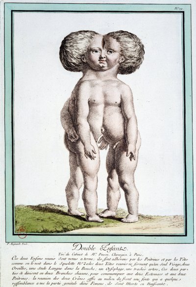 Siamesiska barn - i "" Naturens avvikelser"" av Régnault av Jean Baptiste Regnault