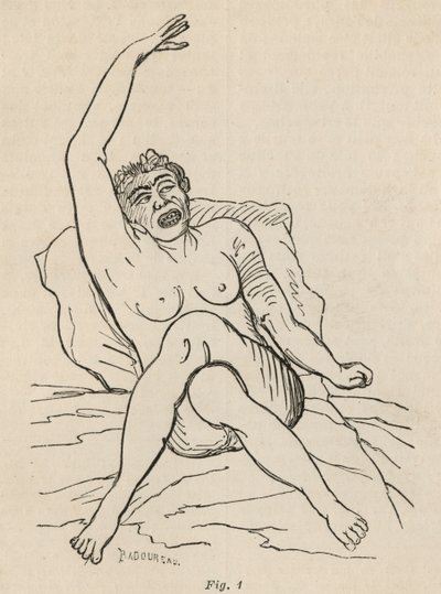Hysterisk epilepsi, attack, vridningar, fig. 1 från 