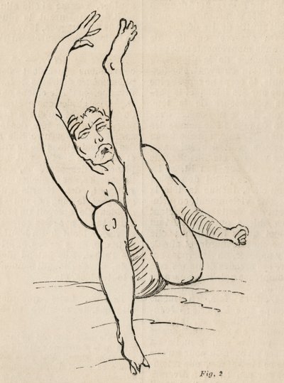 Hysterisk epilepsi, attack, vridningar, fig. 2 från 