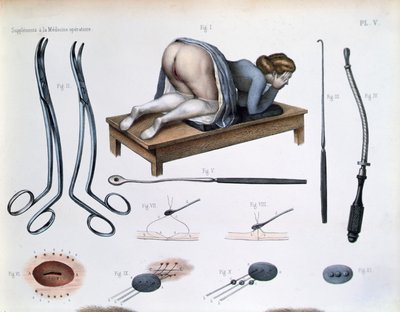 En operation på en vesikovaginal fistel, tallrik från 