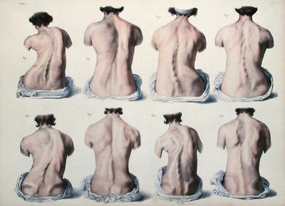 Spinal deformities, tallrik från 