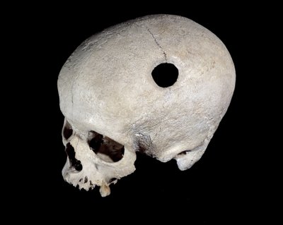 Förhistorisk skalle med trepanationsspår, Museum of National Antiquities. av Prehistoric Prehistoric