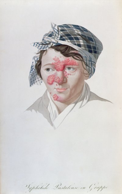 Syfiliska klusterpustler, från en bok av Baron Jean Louis Alibert (1768-1837) 1838 av Salvadore Tresca