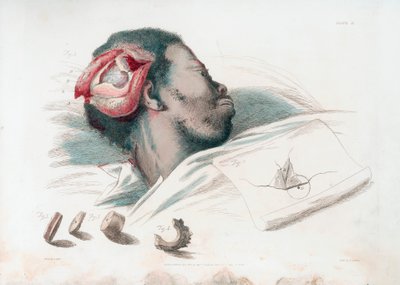 Vy av sår i skallen efter trephination och avlägsnande av krossat benstycke längst ner till vänster, 1821 av Thomas Landseer