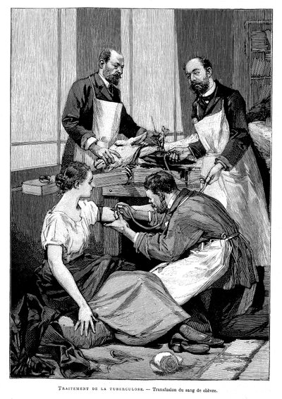 En tuberkulospatient som fick en transfusion av getblod, 1891 av Unbekannt