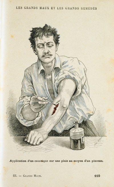 Måla ett sår med en antiseptisk lösning, c1890 av Unbekannt