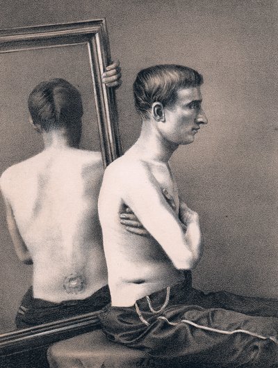 Återställande av en skadad skottskada i buken, amerikanska inbördeskriget, 1865 av Unbekannt