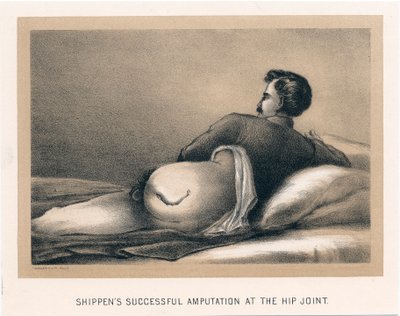 Shippens framgångsrik amputation vid höftleden, amerikanska inbördeskriget, 1865 av Unbekannt